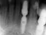 Bicon SHORT Dental Implant Radiograph 0002