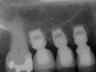Bicon SHORT Dental Implant Radiograph 0023