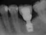 Bicon SHORT Dental Implant Radiograph 0024