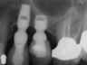 Bicon SHORT Dental Implant Radiograph 0030