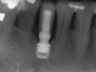 Bicon SHORT Dental Implant Radiograph 0031