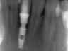Bicon SHORT Dental Implant Radiograph 0039