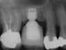 Bicon SHORT Dental Implant Radiograph 0052
