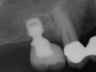 Bicon SHORT Dental Implant Radiograph 0069