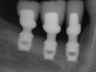 Bicon SHORT Dental Implant Radiograph 0075