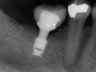 Bicon SHORT Dental Implant Radiograph 0087