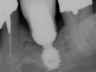 Bicon SHORT Dental Implant Radiograph 0094