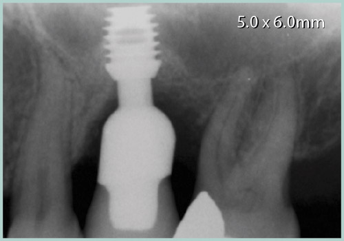 Crown-to-Implant Ratios