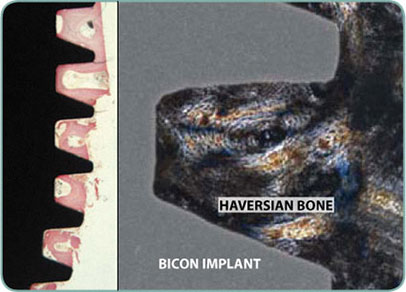 Haversian Bone