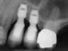 Bicon SHORT Dental Implant Radiograph 0003