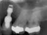 Bicon SHORT Dental Implant Radiograph 0005