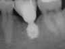 Bicon SHORT Dental Implant Radiograph 0006