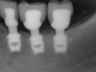 Bicon SHORT Dental Implant Radiograph 0008