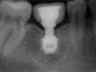 Bicon SHORT Dental Implant Radiograph 0011