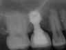 Bicon SHORT Dental Implant Radiograph 0012