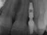 Bicon SHORT Dental Implant Radiograph 0017
