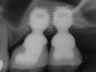 Bicon SHORT Dental Implant Radiograph 0021