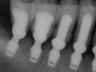 Bicon SHORT Dental Implant Radiograph 0025