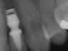 Bicon SHORT Dental Implant Radiograph 0026