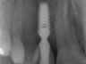 Bicon SHORT Dental Implant Radiograph 0032
