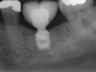 Bicon SHORT Dental Implant Radiograph 0033