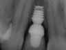 Bicon SHORT Dental Implant Radiograph 0034