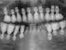 Bicon SHORT Dental Implant Radiograph 0035