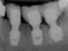 Bicon SHORT Dental Implant Radiograph 0037