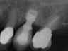 Bicon SHORT Dental Implant Radiograph 0038