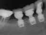 Bicon SHORT Dental Implant Radiograph 0042