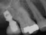 Bicon SHORT Dental Implant Radiograph 0047