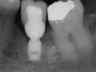 Bicon SHORT Dental Implant Radiograph 0048