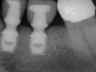 Bicon SHORT Dental Implant Radiograph 0049