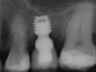 Bicon SHORT Dental Implant Radiograph 0050