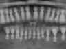 Bicon SHORT Dental Implant Radiograph 0051