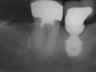 Bicon SHORT Dental Implant Radiograph 0053