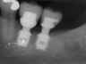 Bicon SHORT Dental Implant Radiograph 0058