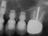 Bicon SHORT Dental Implant Radiograph 0059