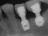 Bicon SHORT Dental Implant Radiograph 0060