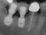 Bicon SHORT Dental Implant Radiograph 0062