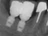 Bicon SHORT Dental Implant Radiograph 0064