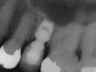 Bicon SHORT Dental Implant Radiograph 0067