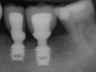 Bicon SHORT Dental Implant Radiograph 0070
