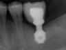 Bicon SHORT Dental Implant Radiograph 0073