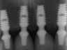 Bicon SHORT Dental Implant Radiograph 0074