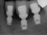 Bicon SHORT Dental Implant Radiograph 0077