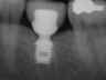 Bicon SHORT Dental Implant Radiograph 0079