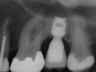 Bicon SHORT Dental Implant Radiograph 0081