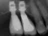 Bicon SHORT Dental Implant Radiograph 0085