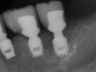 Bicon SHORT Dental Implant Radiograph 0086